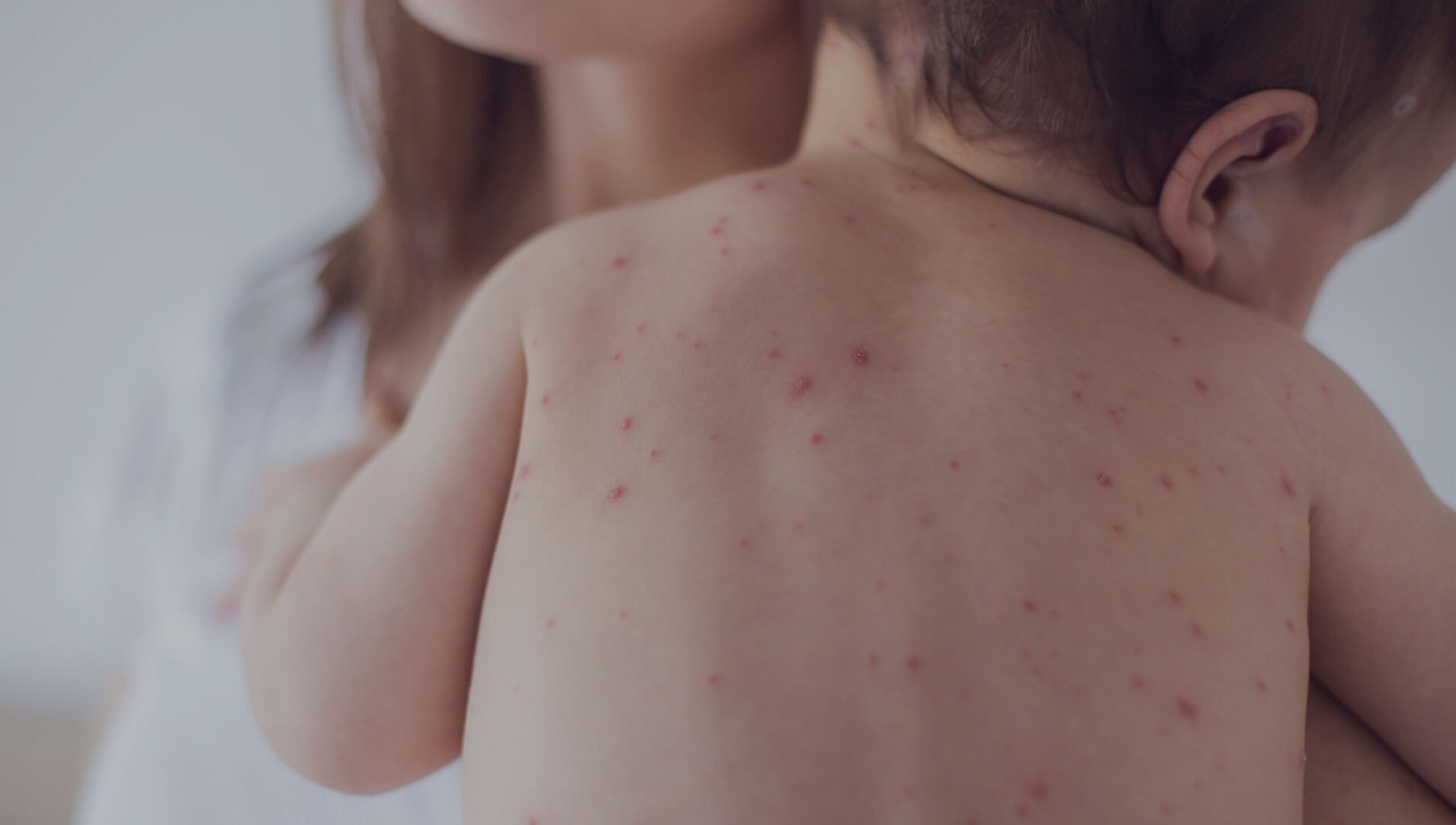 #79 Epidemia de Sarampo: De quem é a culpa?