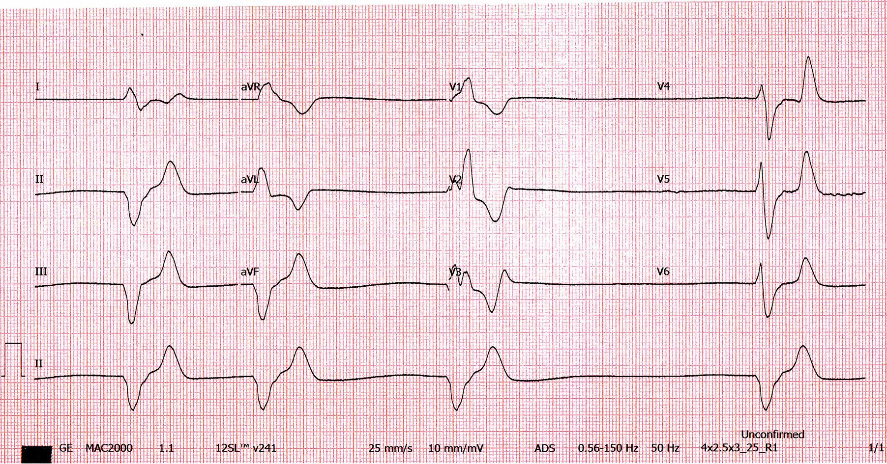 #121 Estimulação Cardíaca Artificial – Entrevista com Leomar Zeferino